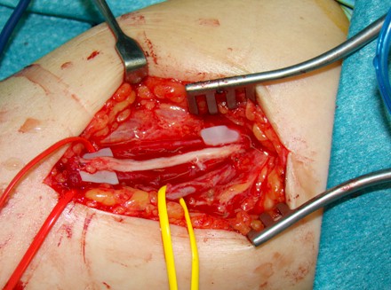 Schwannoma_nervio_mediano/injerto_anastomosis_sural