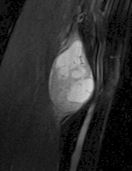 Schwannoma_nervio_mediano/resonancia_magnetica_brazo