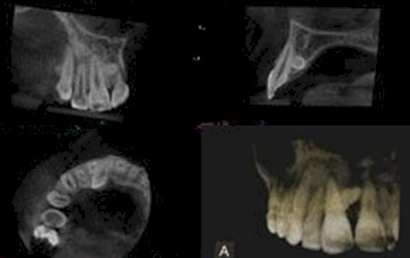 TAC_haz_conico/CBCT_dientes_retenidos
