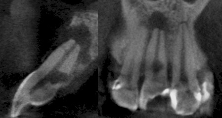 TAC_haz_conico/espacio_periodontal_CBCT
