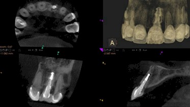 TAC_haz_conico/evaluacion_prequirurgica_CBCT
