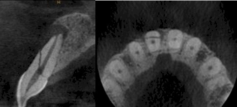 TAC_haz_conico/identificacion_fracturas_dentarias