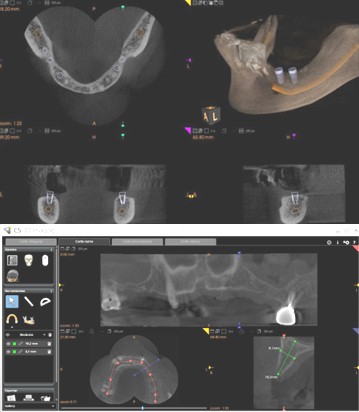 TAC_haz_conico/implantologia_estructuras_anatomicas