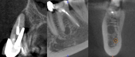 TAC_haz_conico/patologia_periapical_CBCT