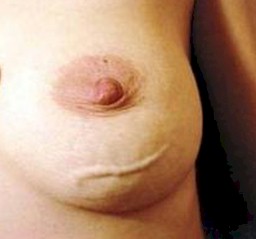 caso_sindrome_Mondor/tromboflebitis_mamaria_toracica