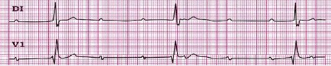 conocimientos_electrocardiografia_ECG/bloqueo_AV_tercer_grado