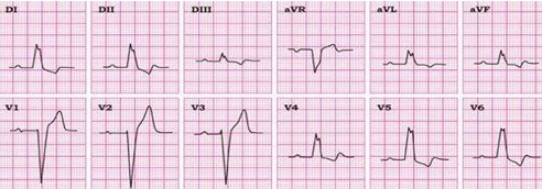 conocimientos_electrocardiografia_ECG/bloqueo_completo_rama_izquierda