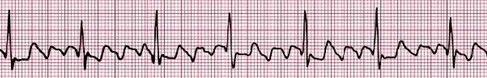 conocimientos_electrocardiografia_ECG/flutter_auricular_arritmia