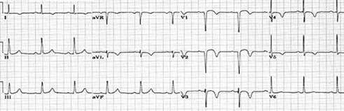 conocimientos_electrocardiografia_ECG/infarto_agudo_miocardio