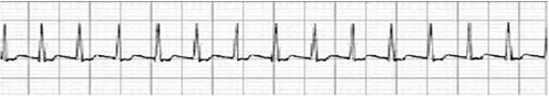 conocimientos_electrocardiografia_ECG/taquicardia_paroxistica_supraventricular