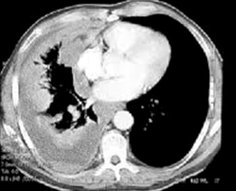 derrame_pleural_primaria/TAC_engrosamiento_pleural