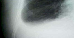 derrame_pleural_primaria/TEP_tromboembolismo_pulmonar