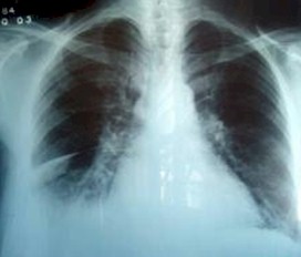 derrame_pleural_primaria/insuficiencia_cardiaca_ICC
