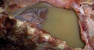 derrame_pleural_primaria/quilotorax_conducto_toracico