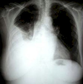 derrame_pleural_primaria/radiografia_Rx_toracica