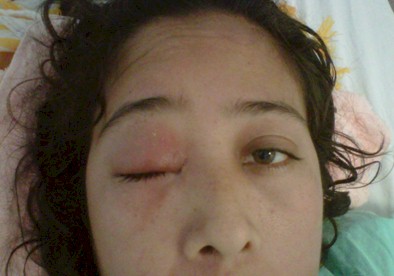 enfermedad_Chagas_caso/edema_parpado_palpebral