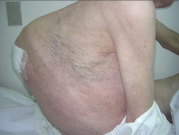 enfermedad_Ollier_neuropatia/cifoescoliosis_cifoscoliosis_dorsal