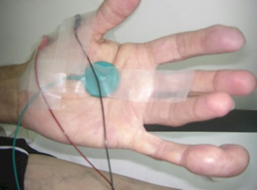 enfermedad_Ollier_neuropatia/deformidad_dedo_pulgar