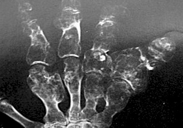 enfermedad_Ollier_neuropatia/encondromas_metafisis_Rx