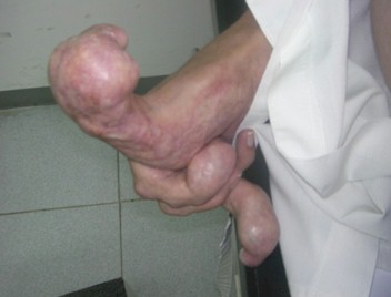 enfermedad_Ollier_neuropatia/masas_tumores_tumoraciones