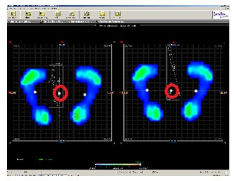 equilibrio_calzado_suela/estabilometriaanalisis_estadistica
