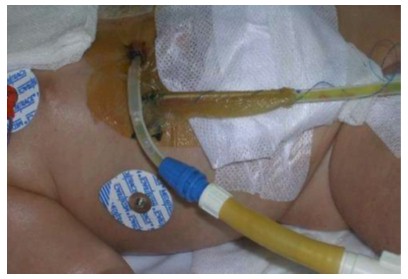 germenes_dialisis_peritoneal/cateter_dialisis_abdomen