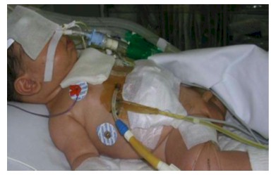 germenes_dialisis_peritoneal/cateter_dialisis_peritoneal
