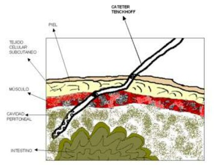 germenes_dialisis_peritoneal/punto_entrada_cateter