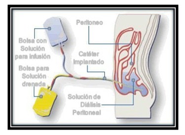 germenes_dialisis_peritoneal/solucion_bolsa_cateter