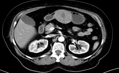 hemorragia_digestiva_alta/TAC_masa_tumor_estomago