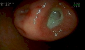 hemorragia_digestiva_alta/endoscopia_ulcera_gastrica