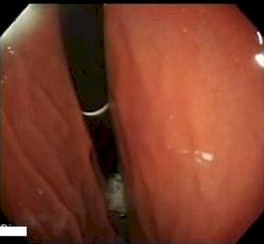 imagenes_endoscopicas_epigastralgia/endoscopia_maniobra_retroversion