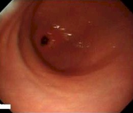 imagenes_endoscopicas_epigastralgia/inflamacion_mucosa_antral