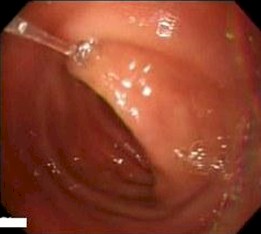 imagenes_endoscopicas_epigastralgia/inflamacion_mucosa_duodeno