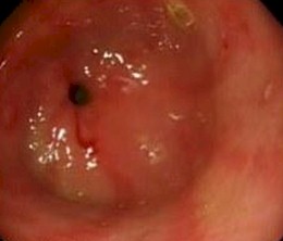 imagenes_endoscopicas_epigastralgia/lesion_erosiva_gastrica