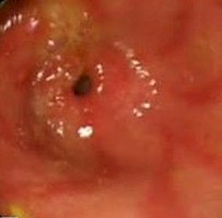 imagenes_endoscopicas_epigastralgia/mucosa_antral_enrojecida