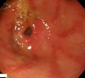 imagenes_endoscopicas_epigastralgia/mucosa_gastrica_piloro