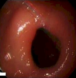 imagenes_endoscopicas_epigastralgia/piloro_orificio_pilorico