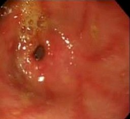 imagenes_endoscopicas_epigastralgia/signos_inflamatorios_mucosa