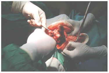 mordeduras_serpientes_venenosas/amputacion_dedos_mano