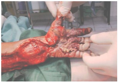 mordeduras_serpientes_venenosas/fasciotomia_sindrome_compartimental