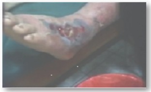 mordeduras_serpientes_venenosas/mordedura_grado_1