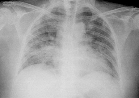 neumonitis_secundaria_metotrexate/caso_clinico_radiografia