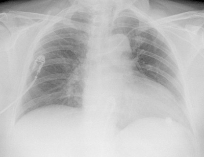 neumonitis_secundaria_metotrexate/mejoria_tratamiento_corticoides