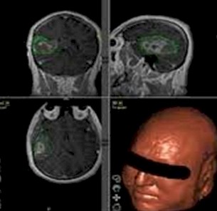 neuronavegacion_neurociencias/cirugia_tumor_cerebral