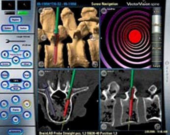 neuronavegacion_neurociencias/neuronavegacion_fijacion_vertebral