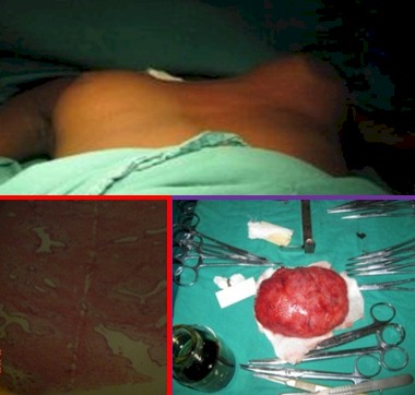 patologia_mamaria_pediatria/cistosarcoma_phyloides_filoides