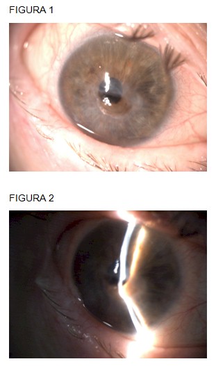 perforacion_ocular_Sjogren/paracorneal_hipotalamia_ojo