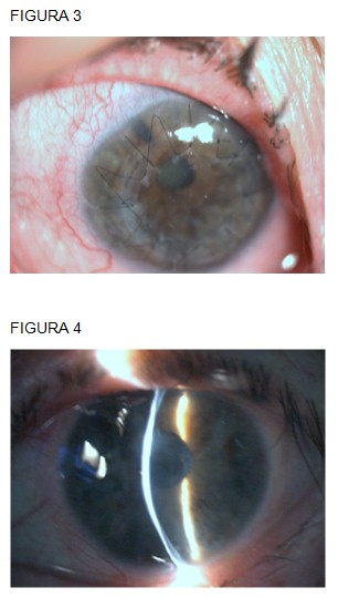 perforacion_ocular_Sjogren/queratoplastia_penetrante_ojo
