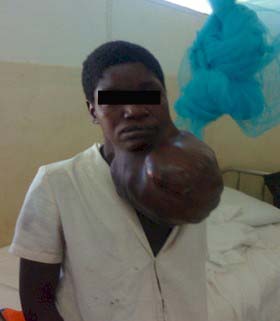 sarcoma_sinovial_gigante/tumor_cuello_cervical